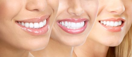 Az otthoni fogfehérítés a fehér mosoly elérésének egyik leggyorsabb, legkényelmesebb és leghozzáférhetőbb módszere. 